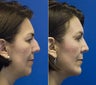 Combined Chin Implant, Rhinoplasty and Upper Lid Blepharoplasty