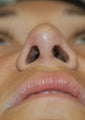 Revision rhinoplasty for collapsed nasal valves, and crooked nose.