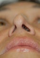 Revision rhinoplasty for collapsed nasal valves, and crooked nose.