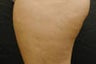 Cellulaze Treatment