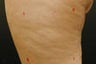 Cellulaze Treatment