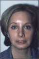 Endoscopic Browlift