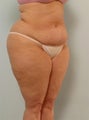 Body Lift