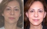 Before and After Neck Lift and Chin Implant