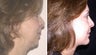 Before and After Neck Lift and Chin Implant