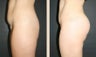 Buttock Augmentation