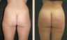 Buttock Augmentation