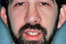 Ear Surgery for Men