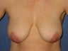 34 Year Old Breast Lift