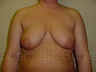 Breast Lift