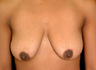 Breast Lift with Breast Augmentation