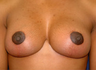 Breast Lift with Breast Augmentation