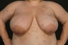 Breast Reconstruction