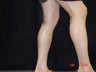 Calf Implants