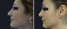 Nose Surgery