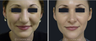 Nose Surgery