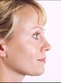 Rhinoplasty