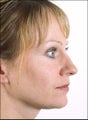 Rhinoplasty