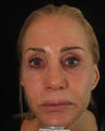 Artefill, Juvederm, Botox - Liquid Face Lift