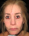 Artefill, Juvederm, Botox - Liquid Face Lift