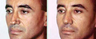 Severely Over-Resected Rhinoplasty Is Corrected