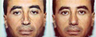Severely Over-Resected Rhinoplasty Is Corrected