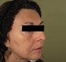 59 yo Woman Treated with Laser Peel and PRP