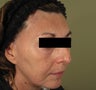 59 yo Woman Treated with Laser Peel and PRP