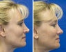 Revision rhinoplasty