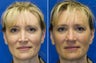 Revision rhinoplasty