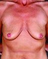 Breast Augmentation with Breast Lift