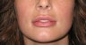 Injectables