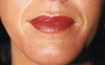 Lip Augmentation