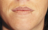 Lip Augmentation