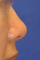 Asian Rhinoplasty