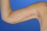 45 Year Old Weight Loss Patient With Arm Laxity