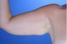45 Year Old Weight Loss Patient With Arm Laxity