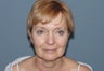Facelift