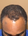 Neograft FUE hair transplant in an African American Male