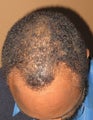 Neograft FUE hair transplant in an African American Male