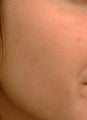 Fraxel laser for acne scars