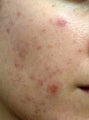 Fraxel laser for acne scars