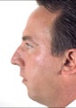 Rhinoplasty and Chin Implant