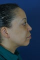 45 yo Female After Neck Liposuction To Improve Her Neckline