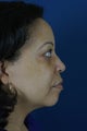 45 yo Female After Neck Liposuction To Improve Her Neckline