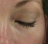 Tear Trough after injection with Restylane