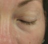Tear Trough after injection with Restylane