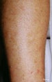 Laser Hair Removal