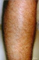 Laser Hair Removal