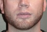 24 Year Old Male Treated For A Weak Jawline